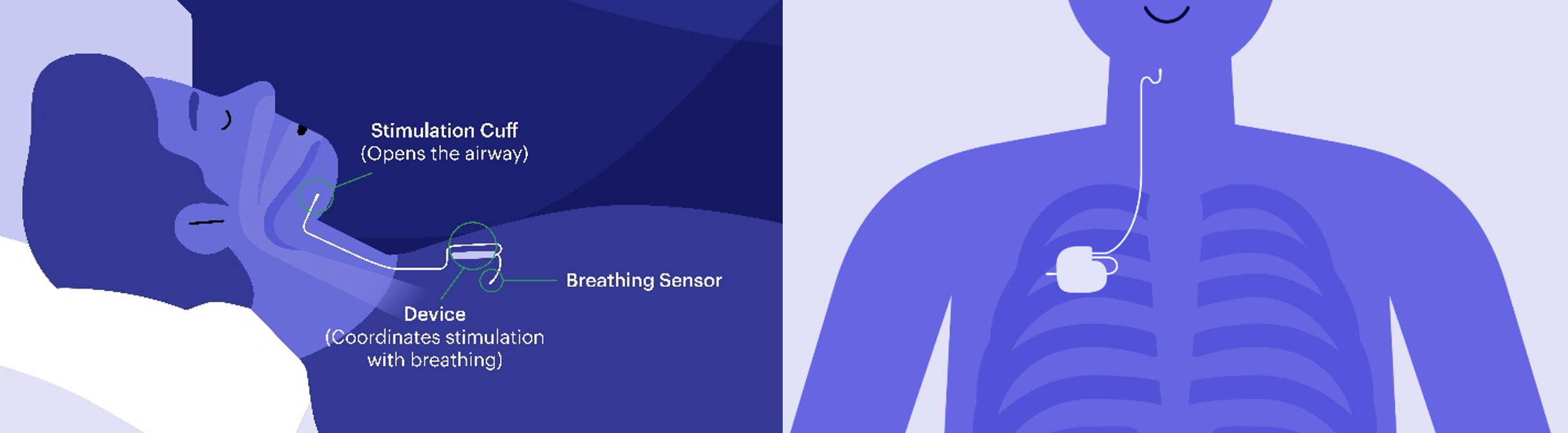 illustrations-of-how-the-implant-is-in-the-body